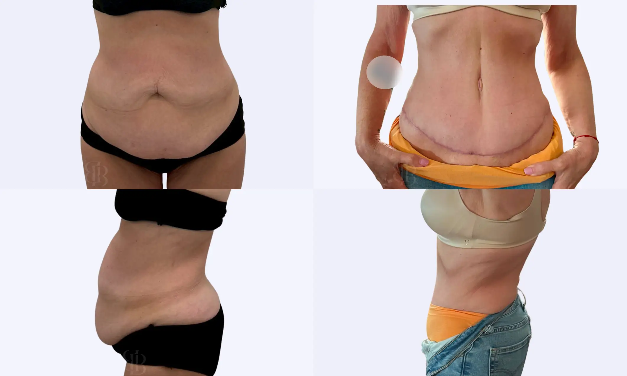 Before after of tummy tuck
