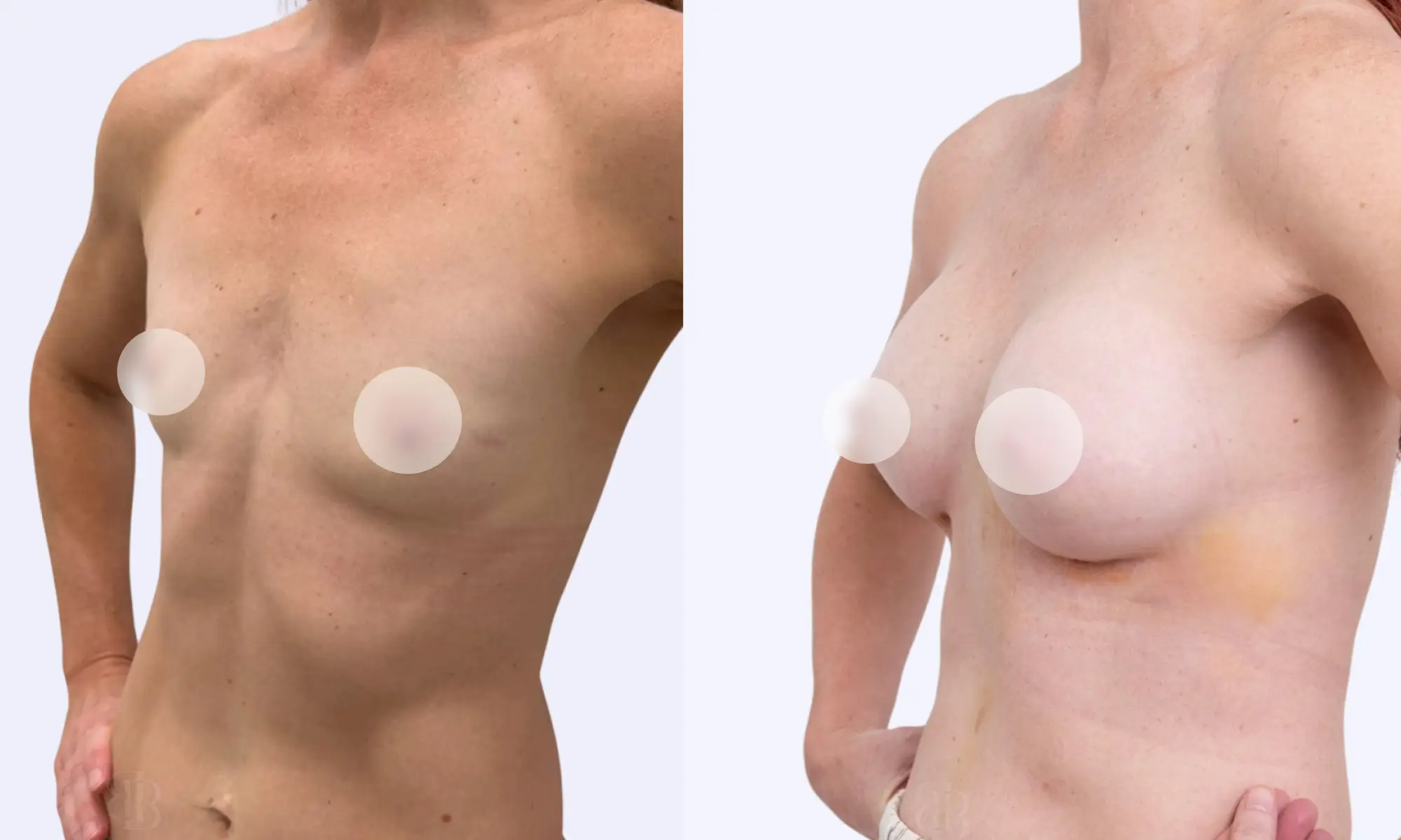 before after breast augmentation
