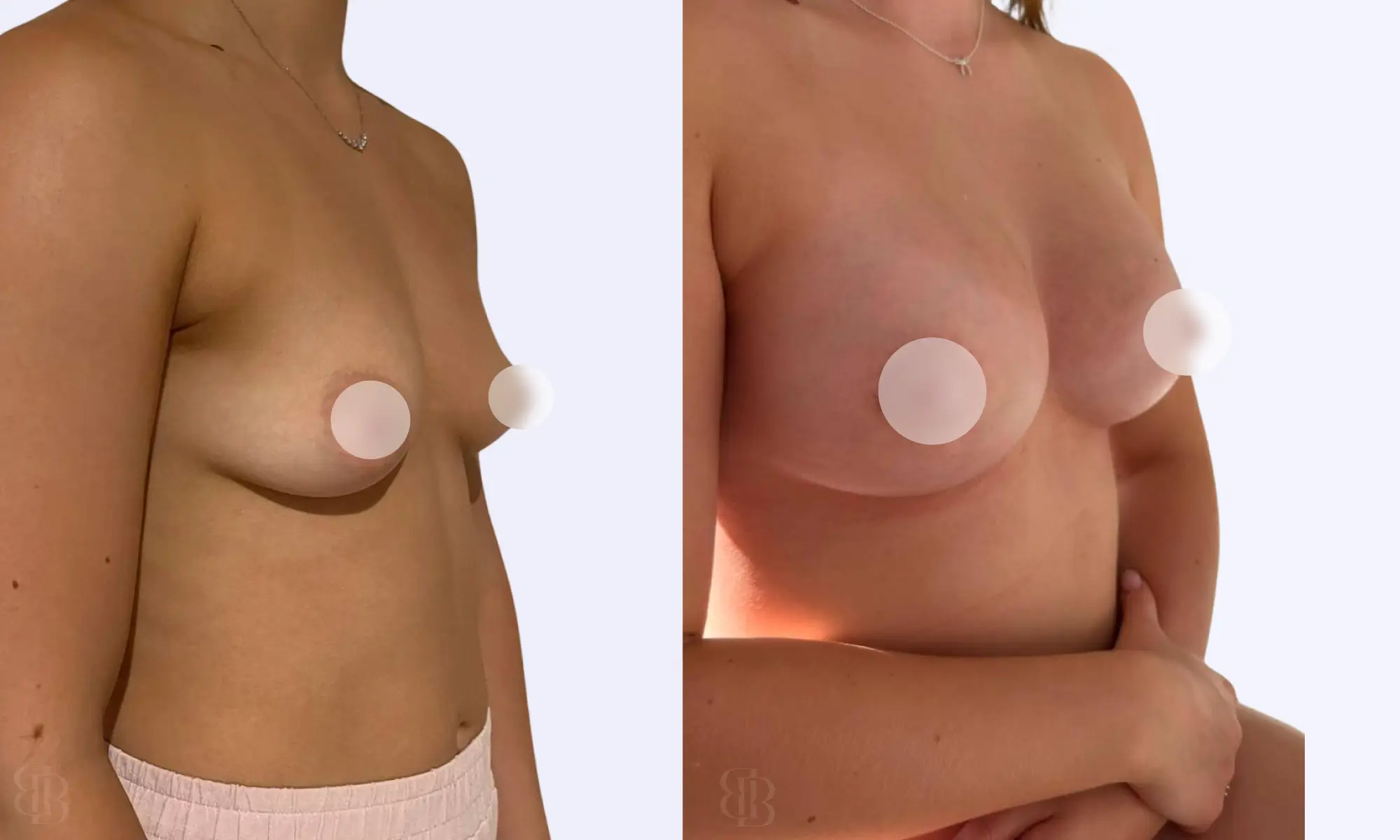 before after breast lift with implants