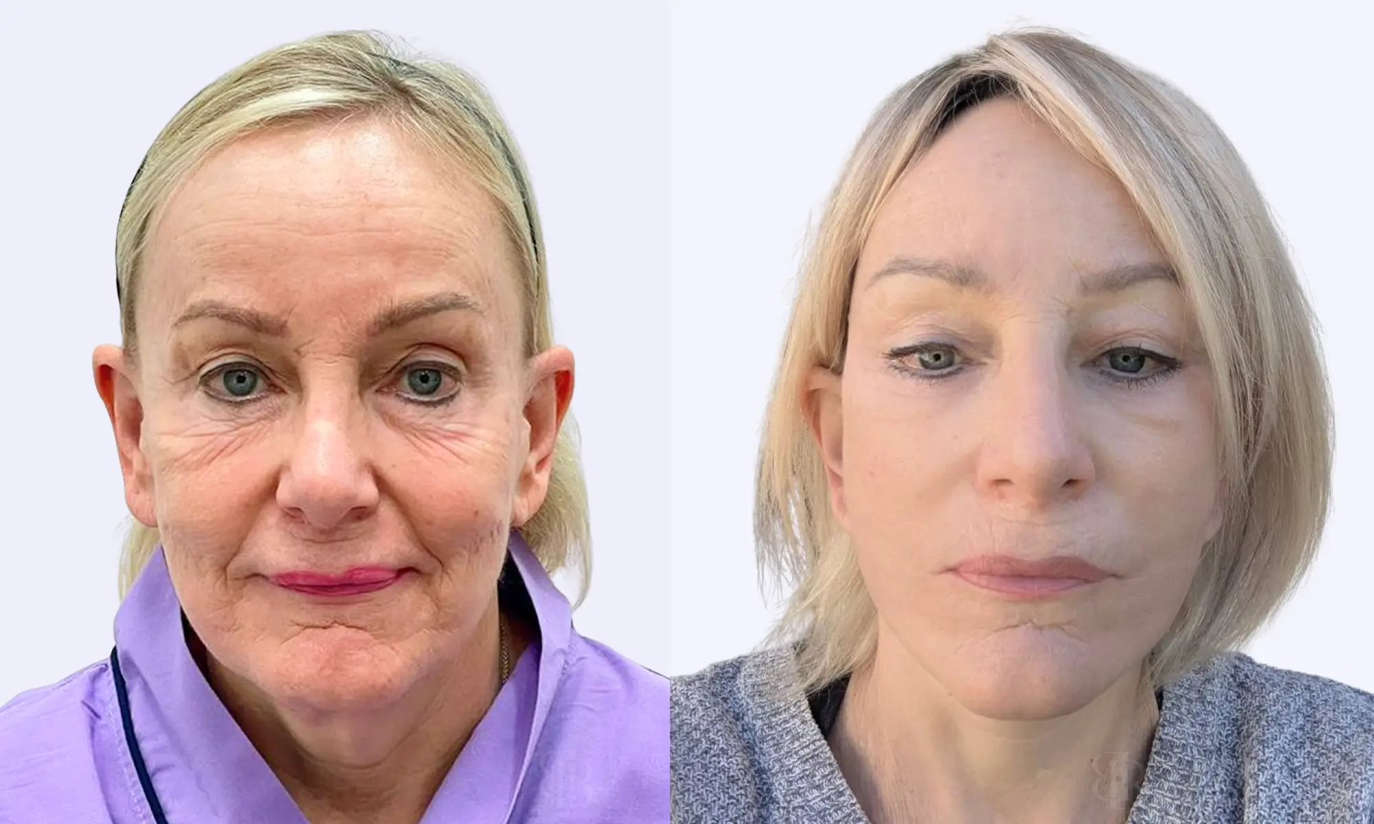 Before & After Facelift