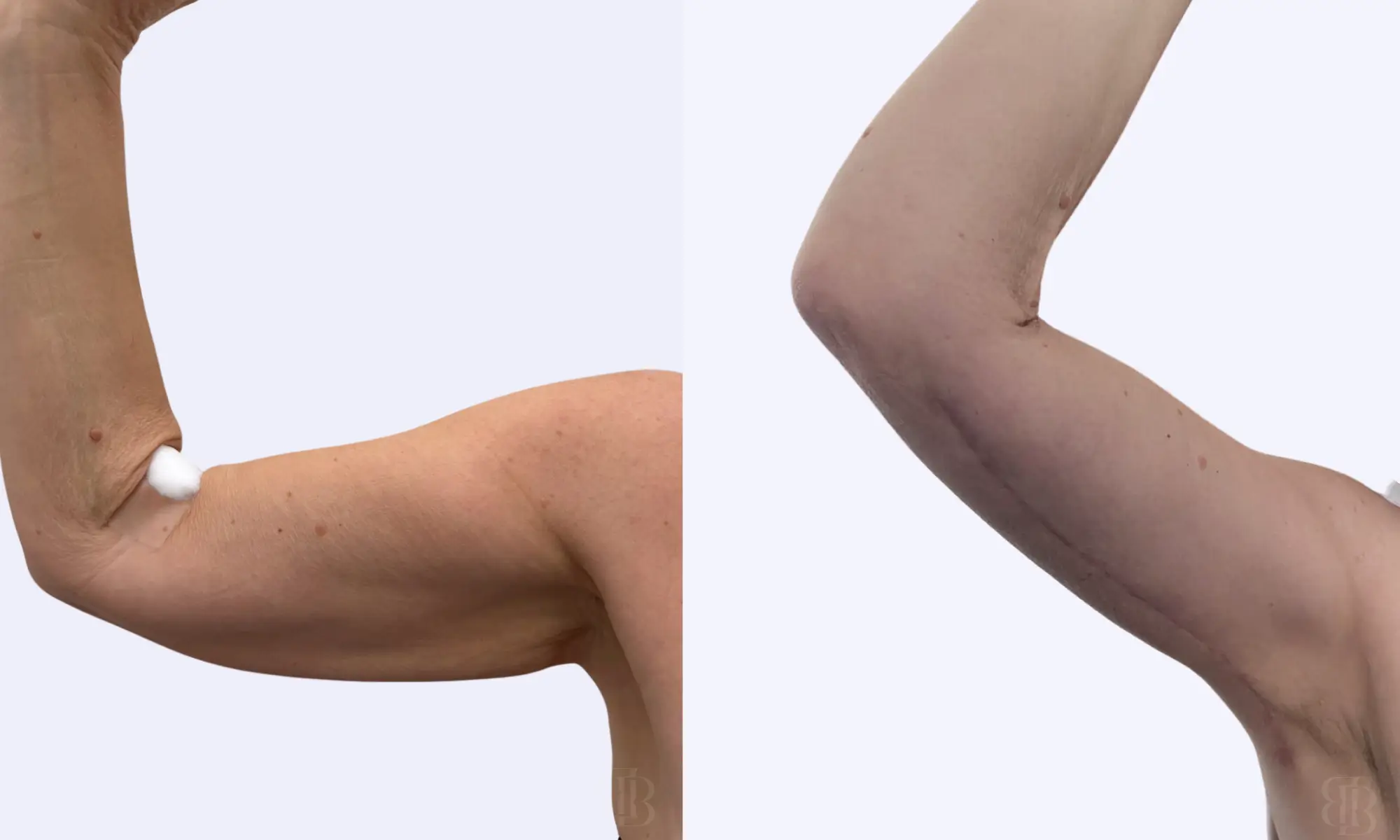 Before & After Armlift