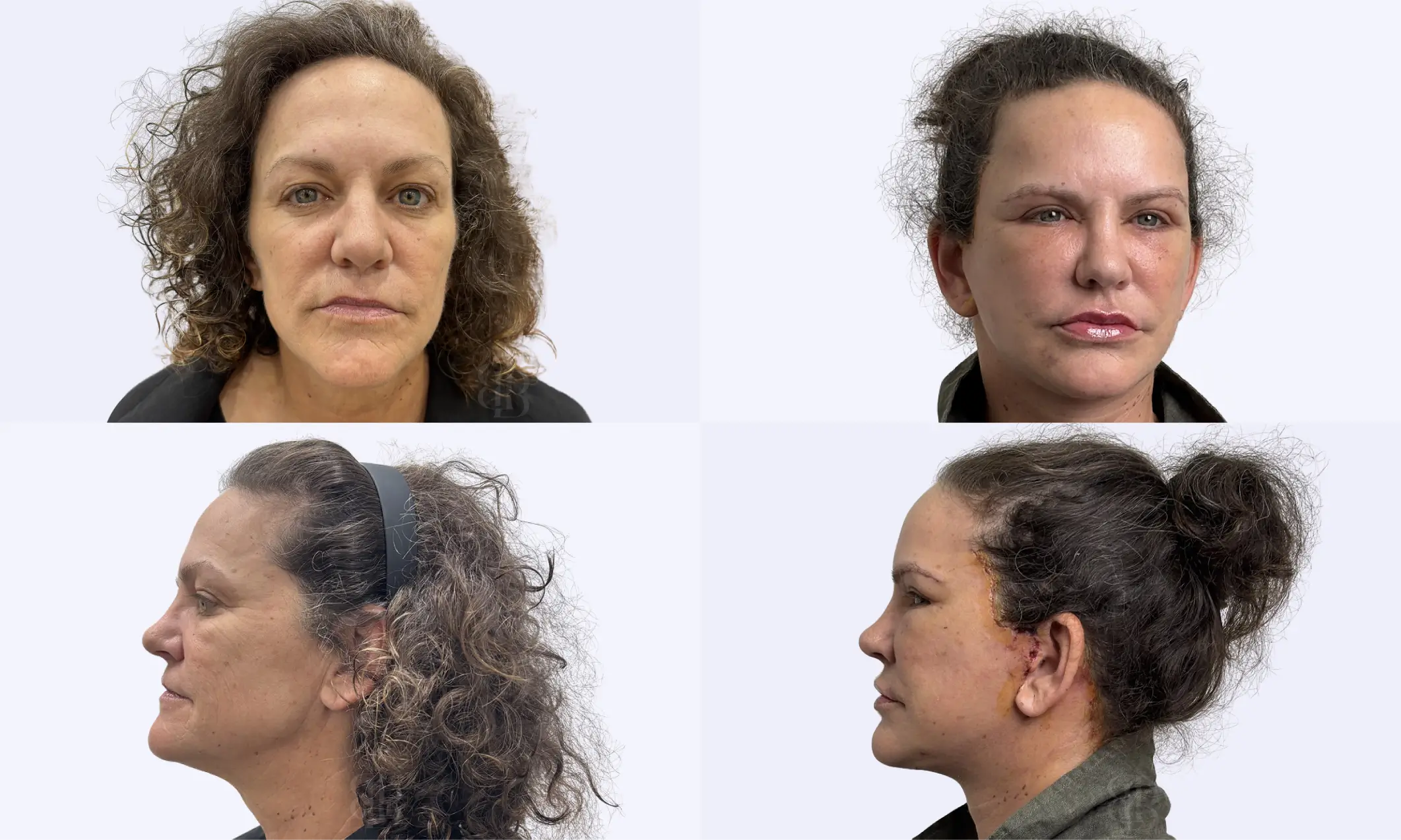 Before & After Facelift
