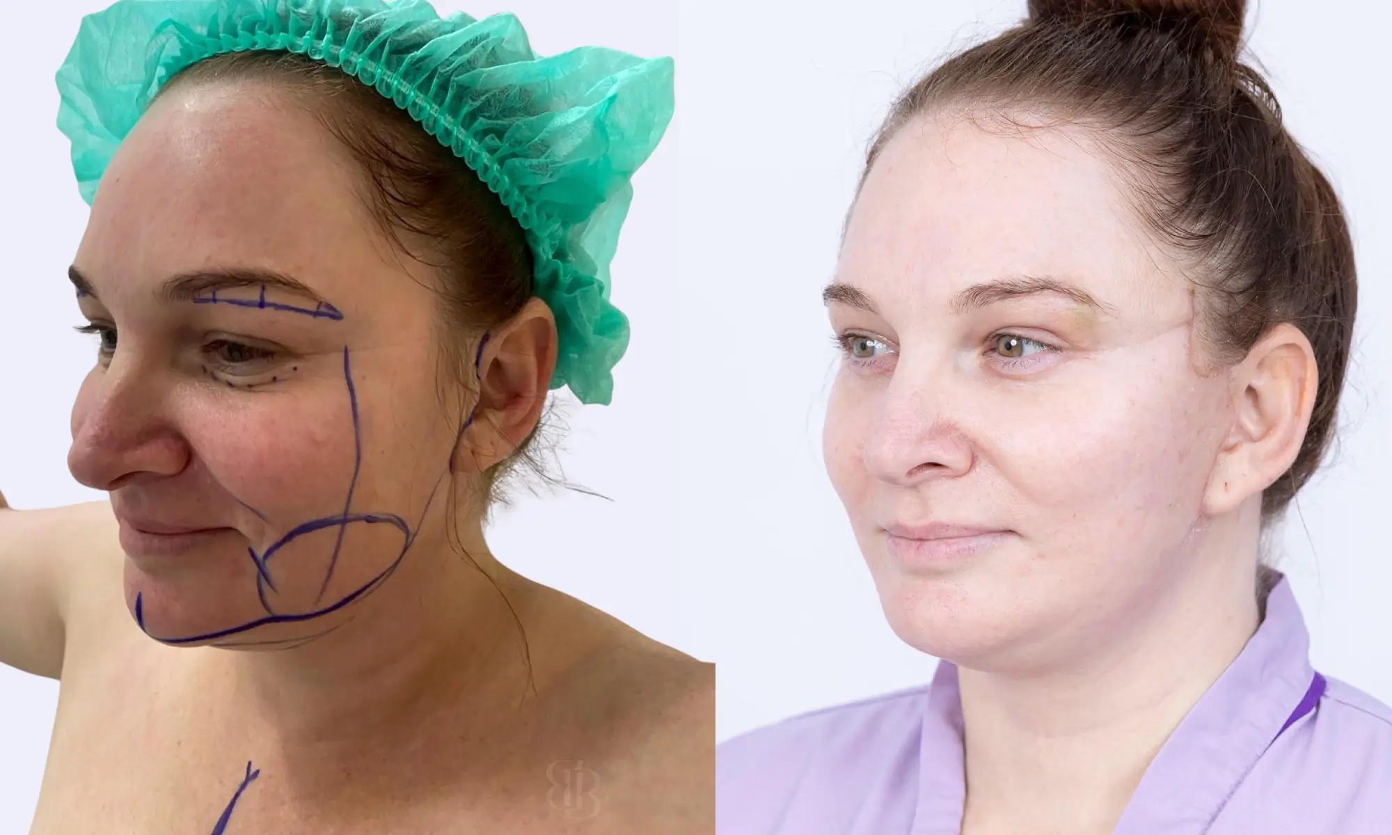 Before & After Facelift 