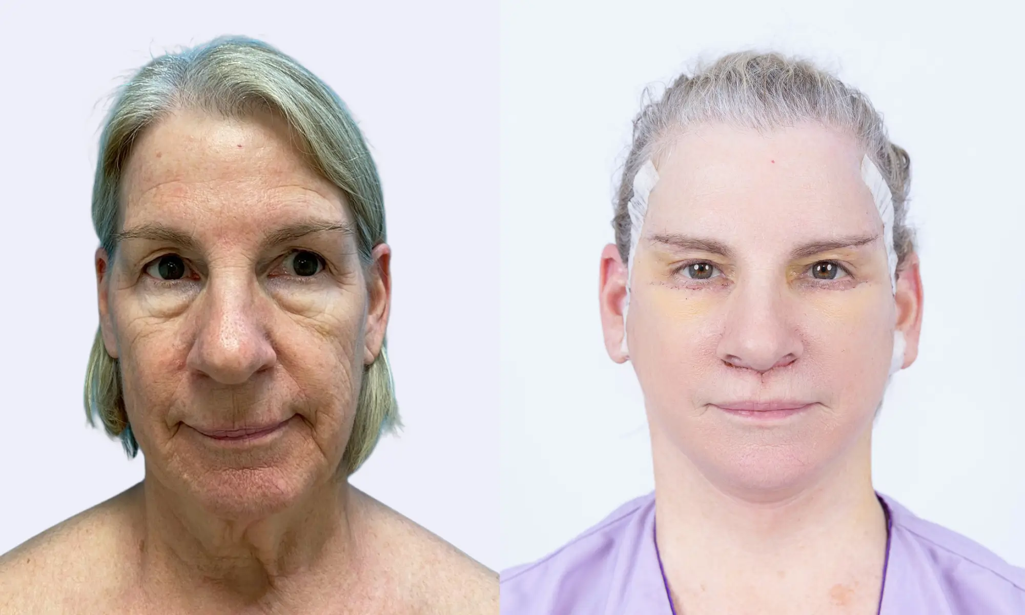 Before & After Facelift 