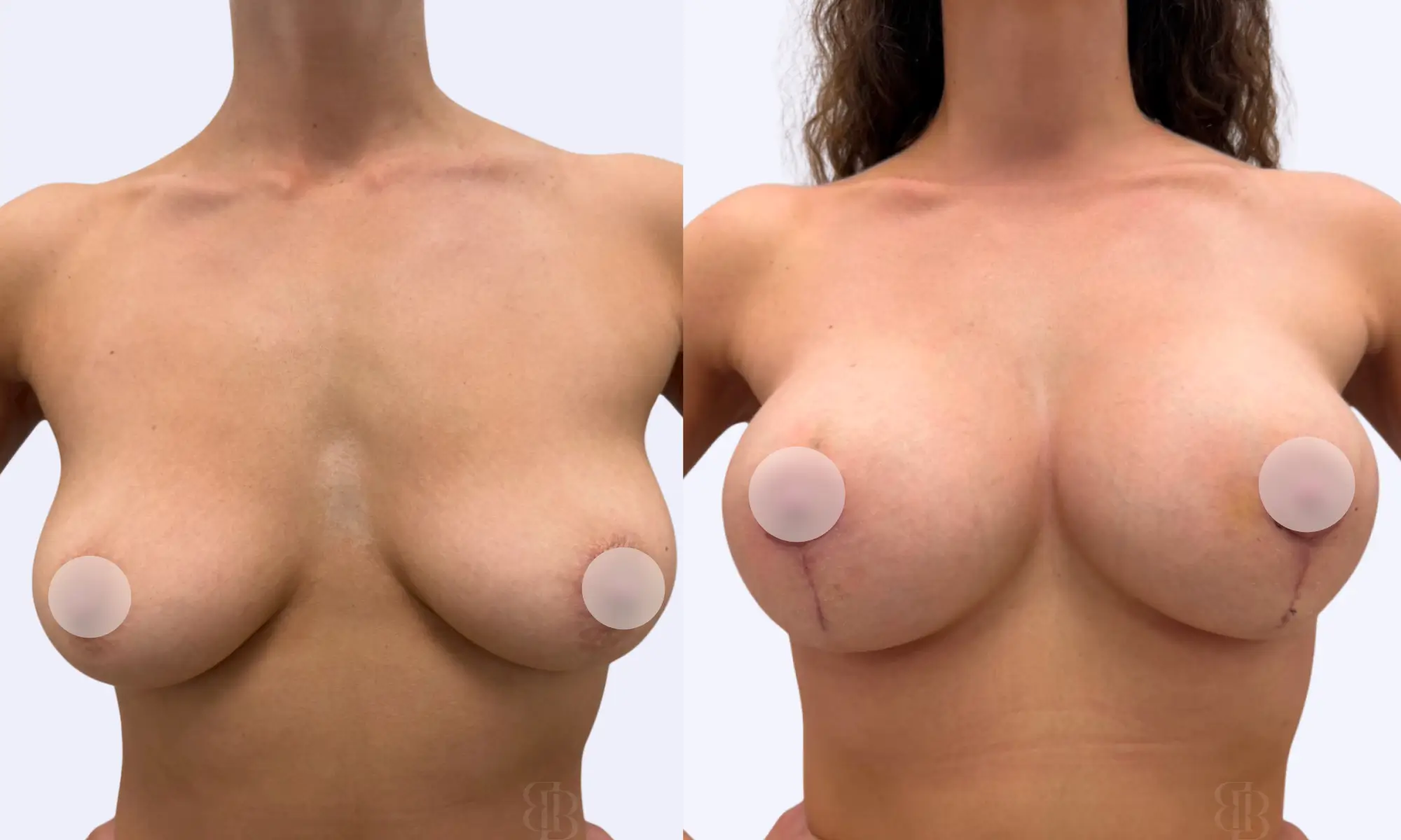Before & After Breast Lift 