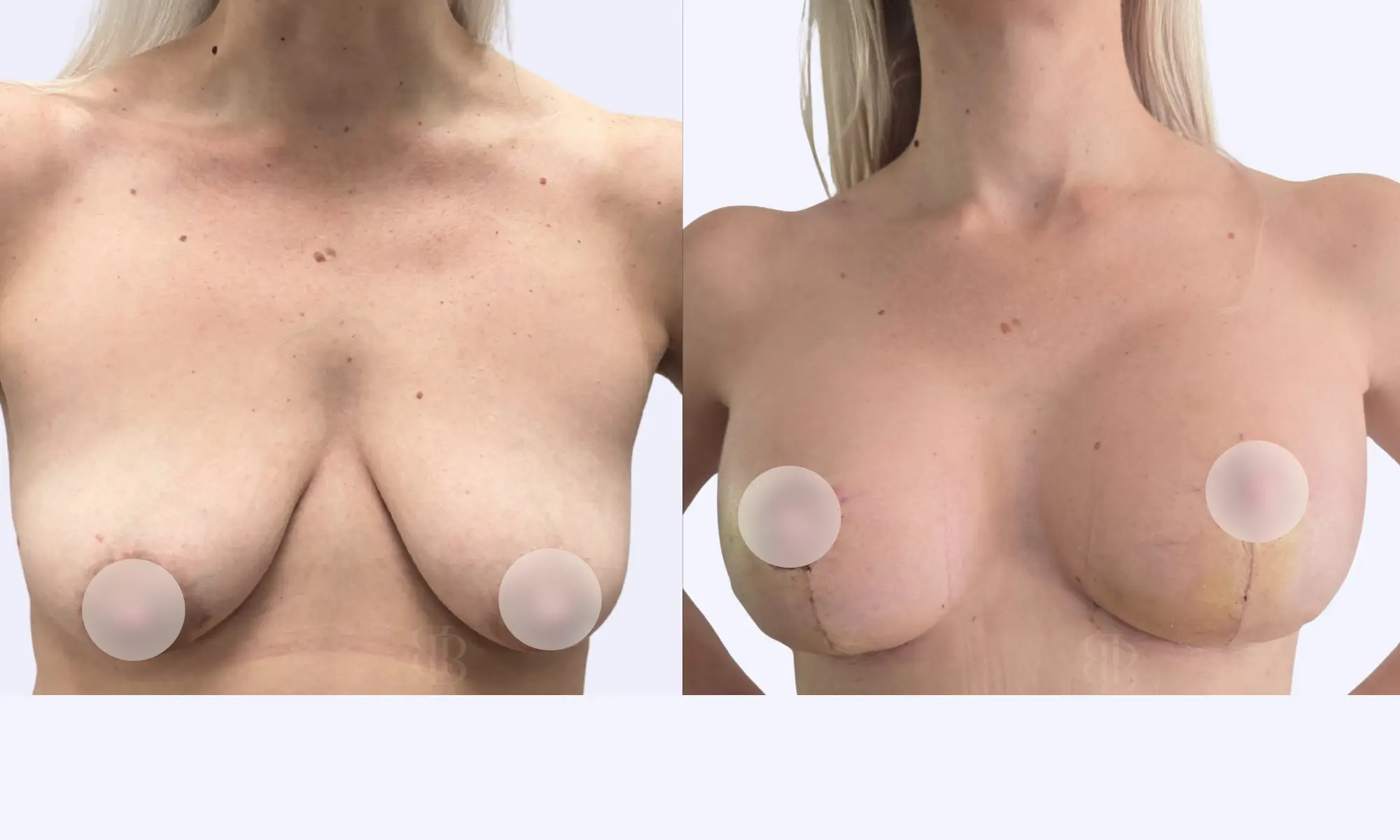 Before & After Breast Lift 
