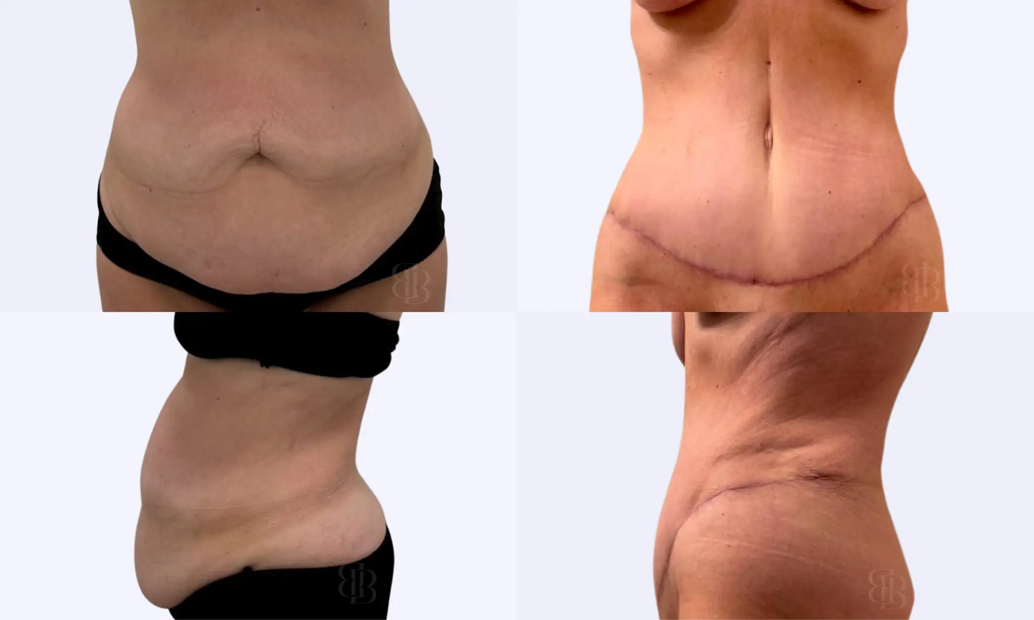 Before & After Tummy Tuck
