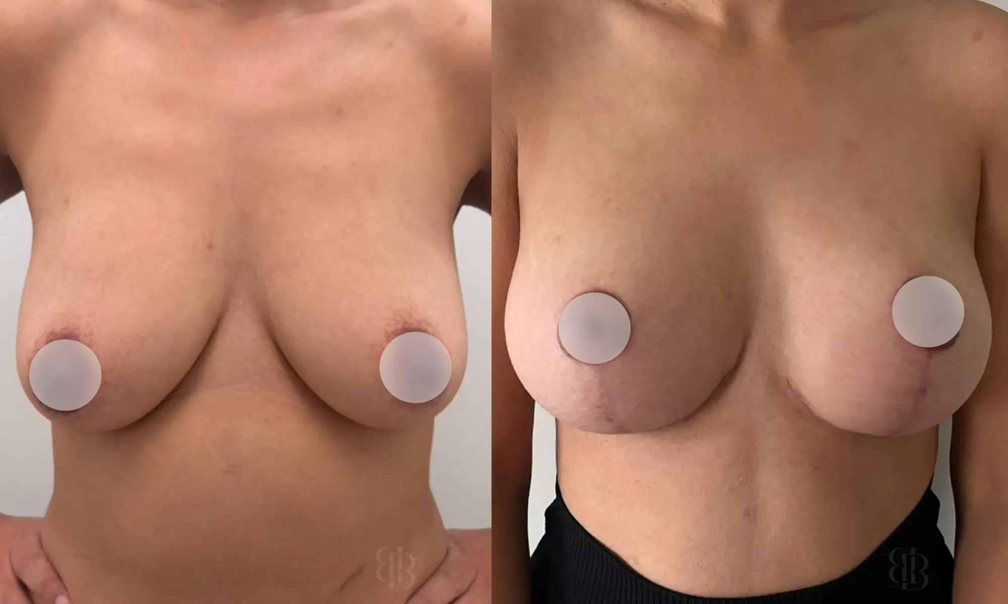 Before & After Breast Lift 