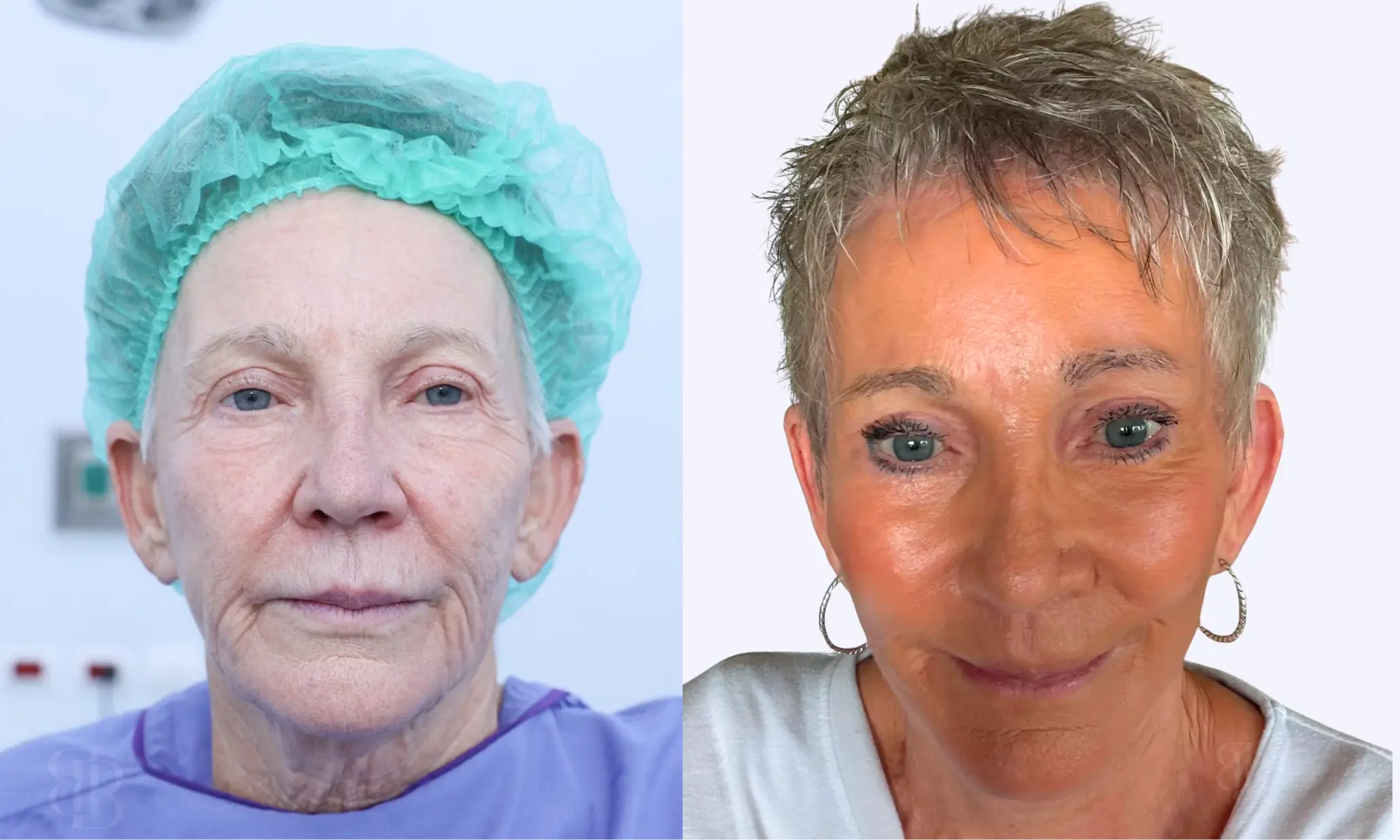 Before & After Face Lift 