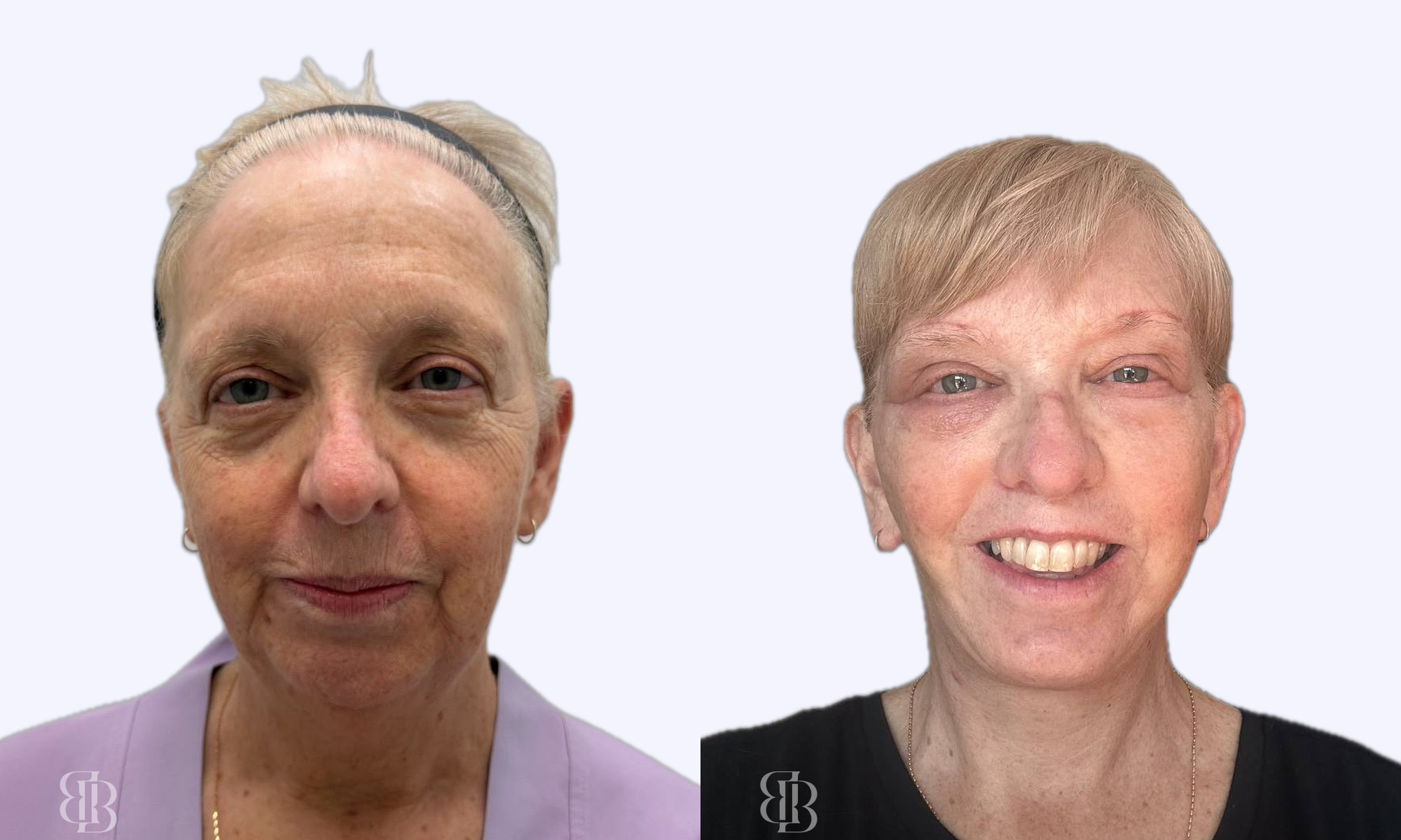 Before & After Facelift