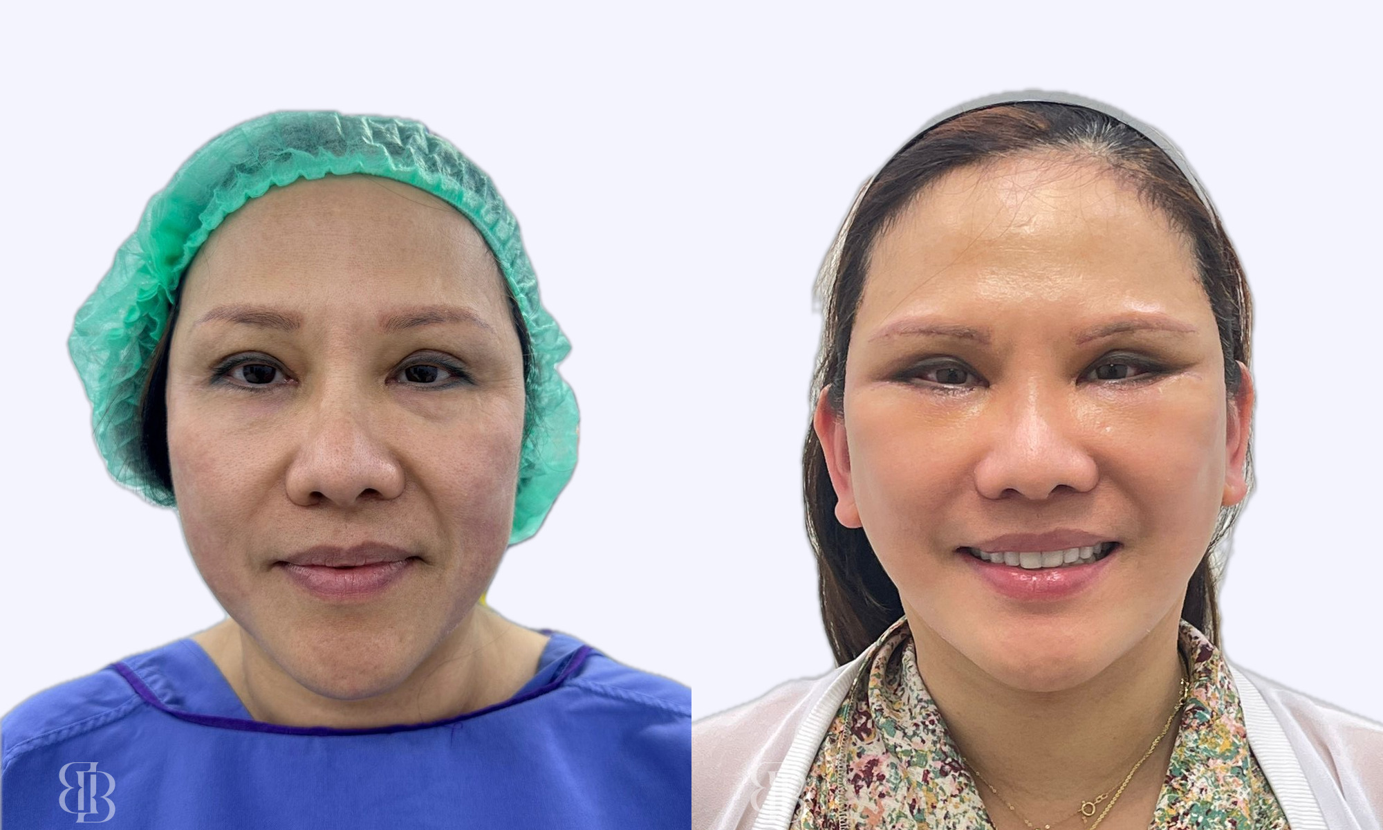 Before & After Facelift