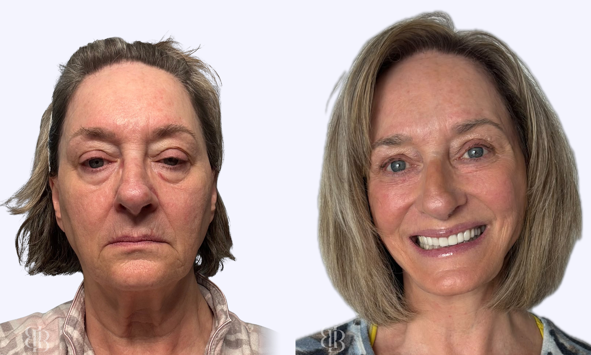 Before & After Facelift