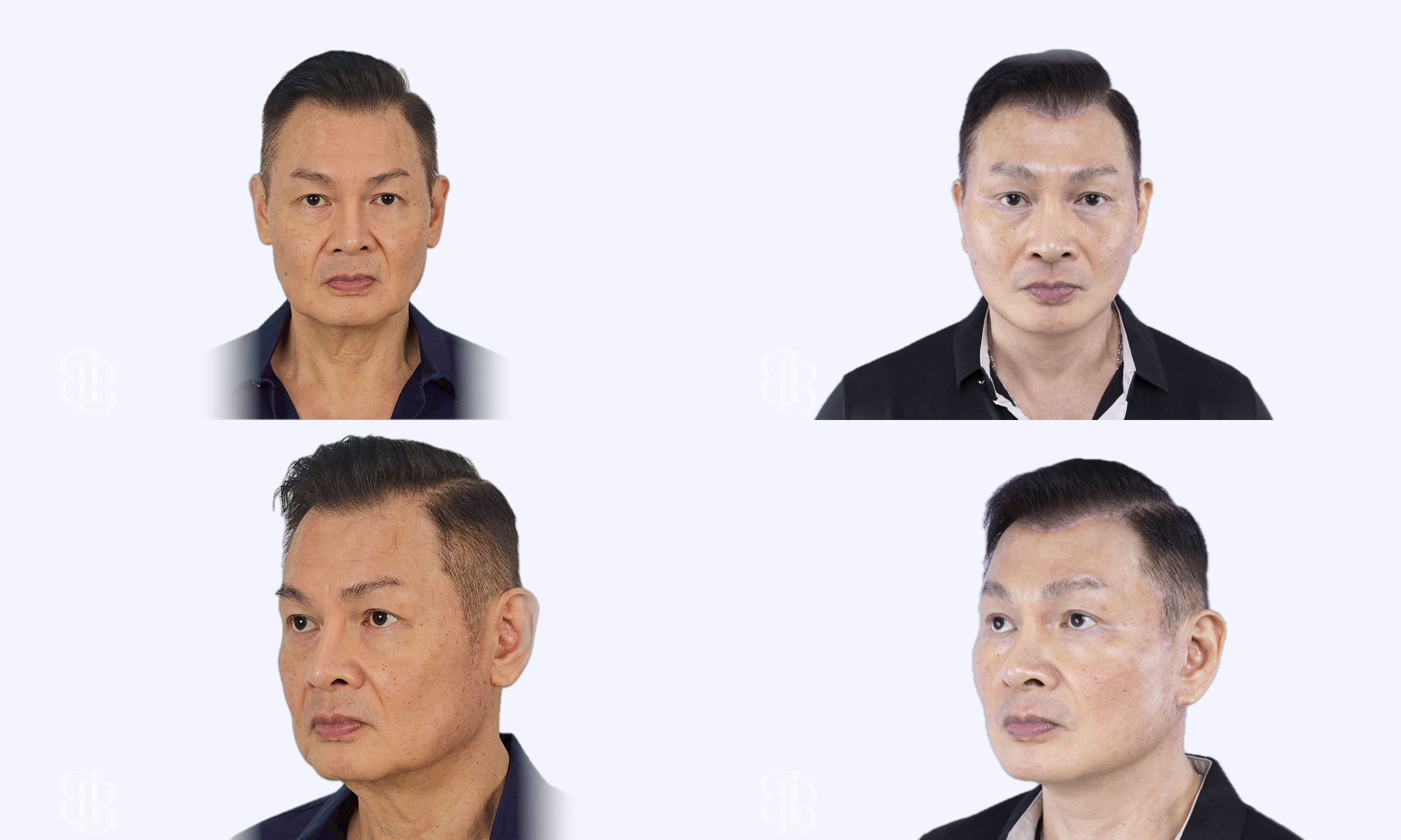 Before & After Facelift