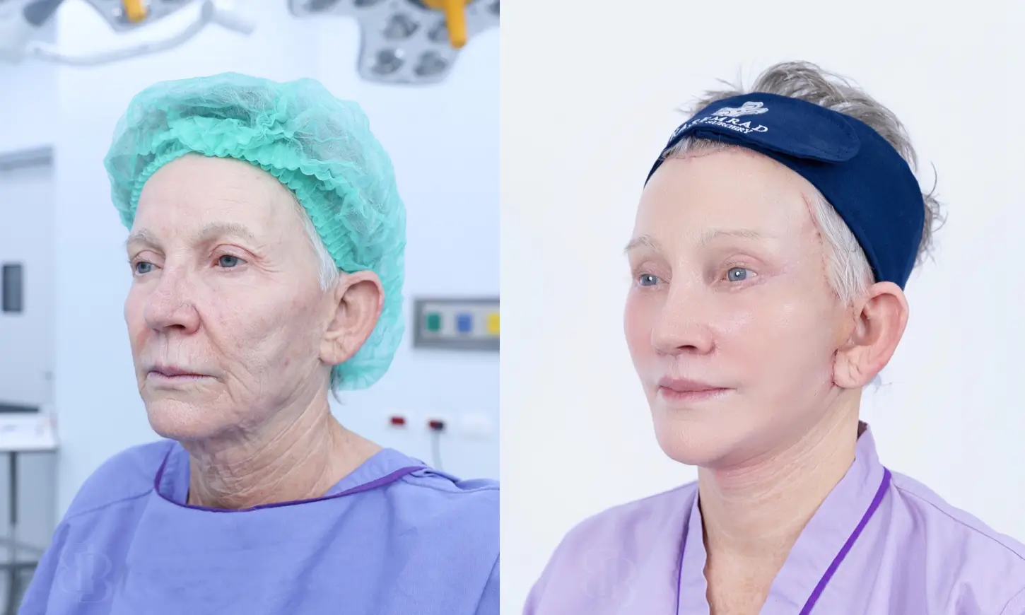 Before & After Deep Plane Facelift