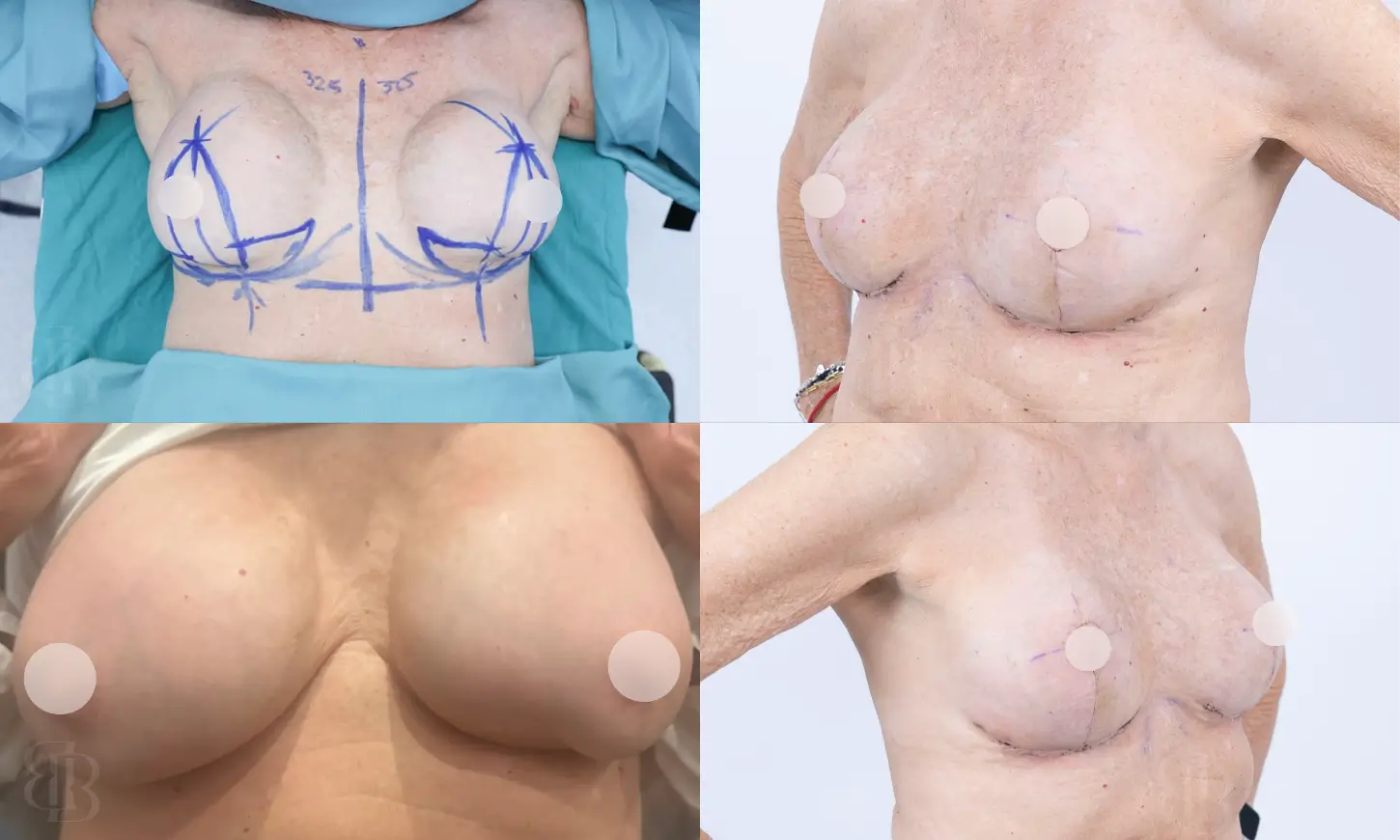 Before & After Breast Lift