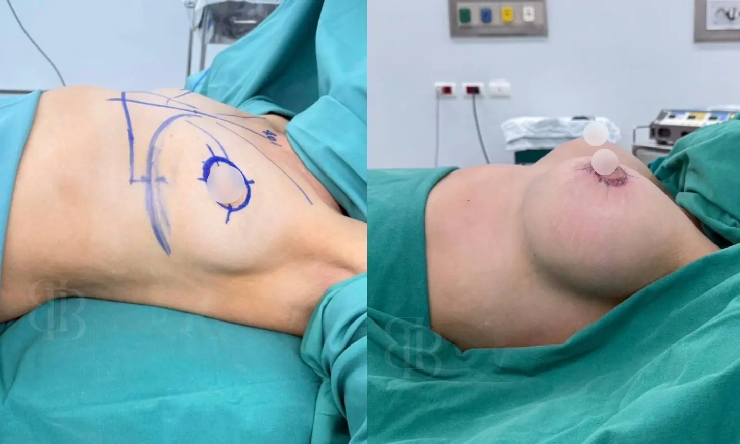Before & After Breast Lift with Implants