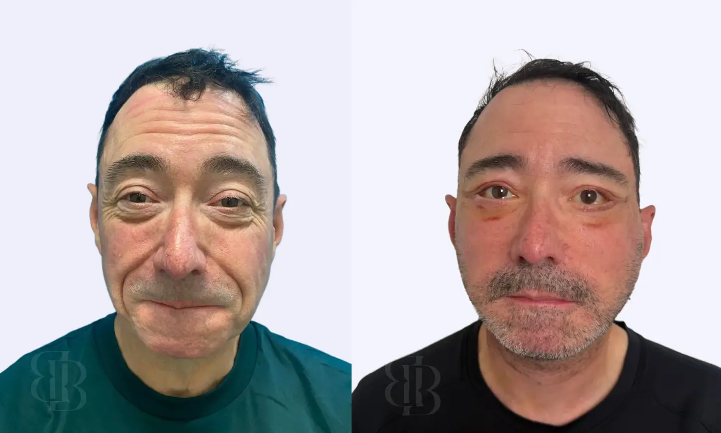 Before & After Deep Plane Facelift