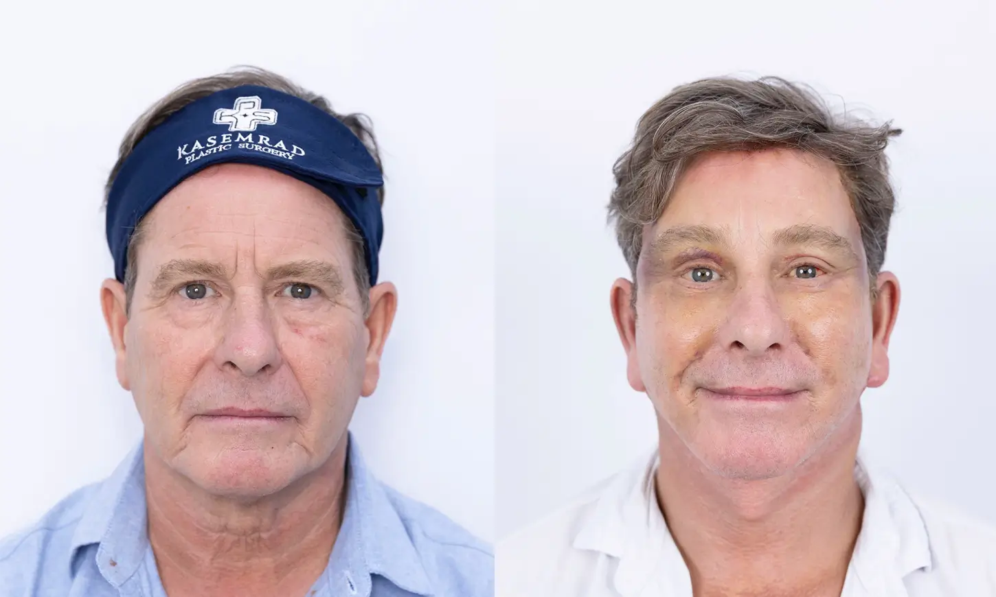 Before & After Deep Plane Facelift
