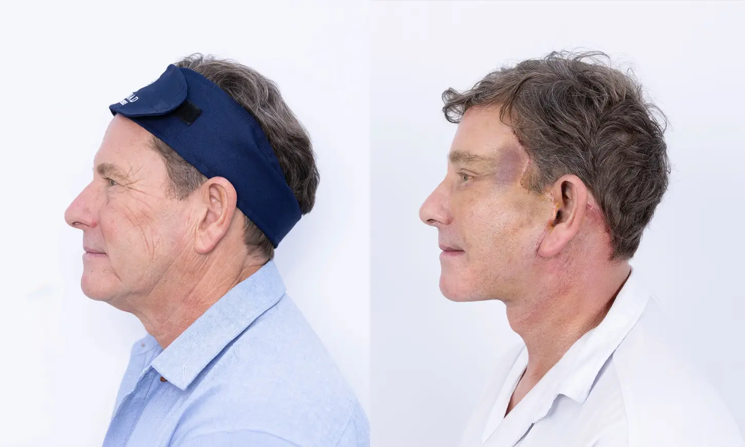 Before & After Deep Plane Facelift