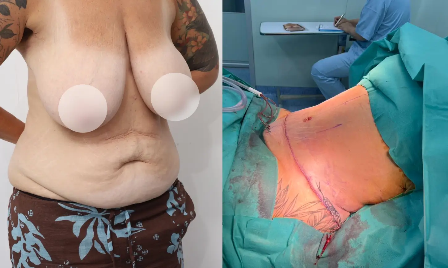Before & After Tummy Tuck