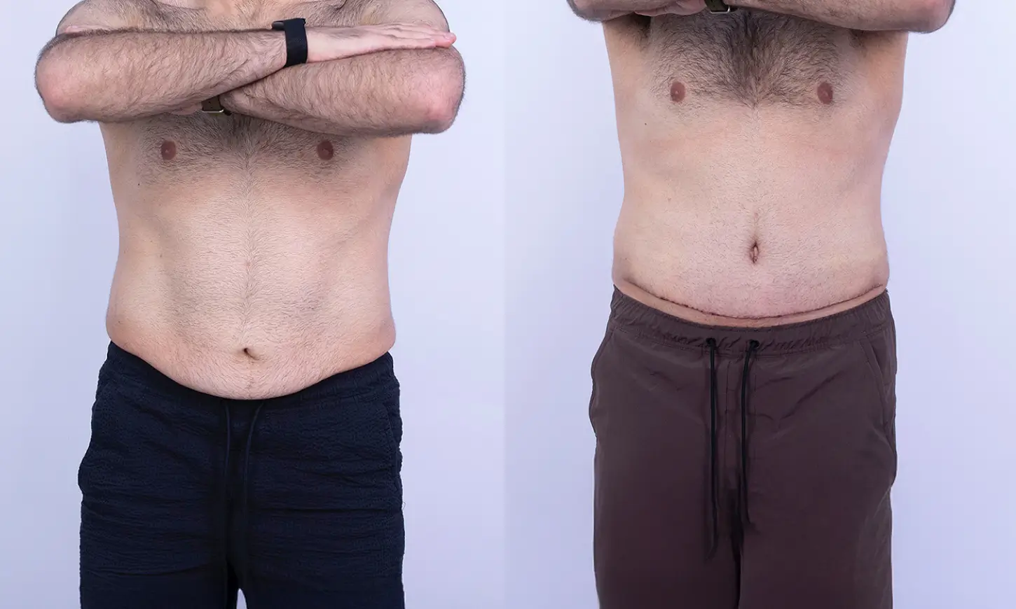 Before & After Tummy Tuck