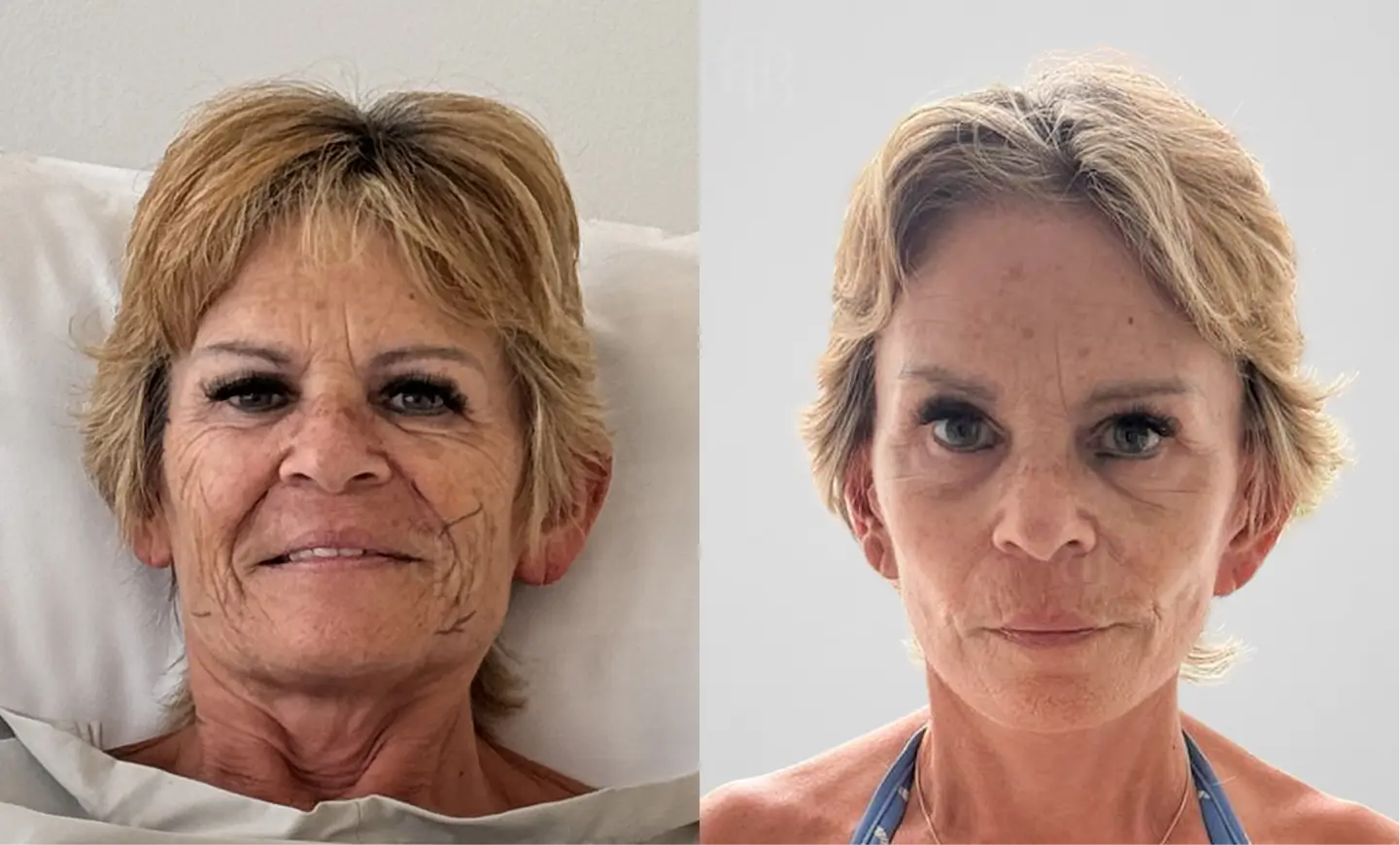 Before & After Deep Plane Facelift