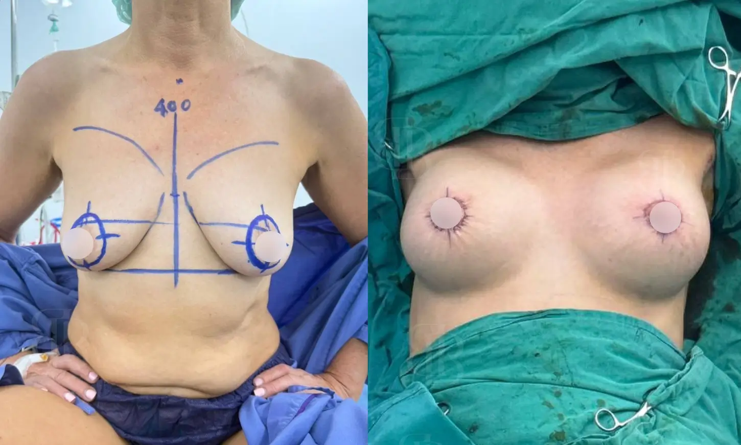 Before & After Breast Lift with Implants