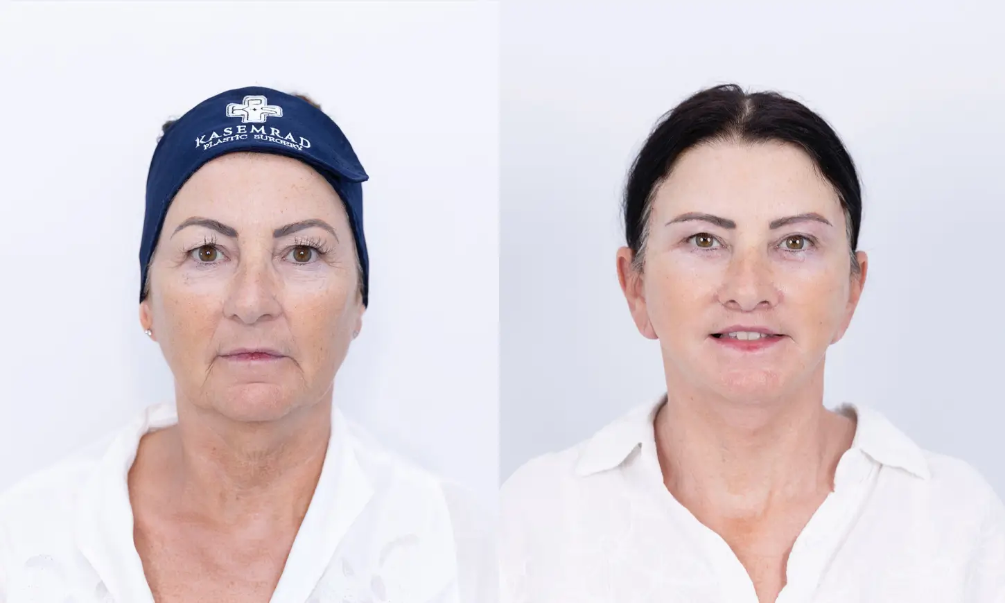 Before & After Deep Plane Facelift
