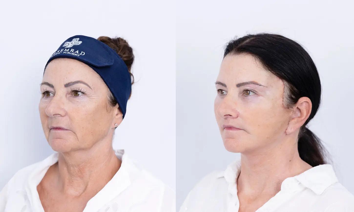 Before & After Deep Plane Facelift
