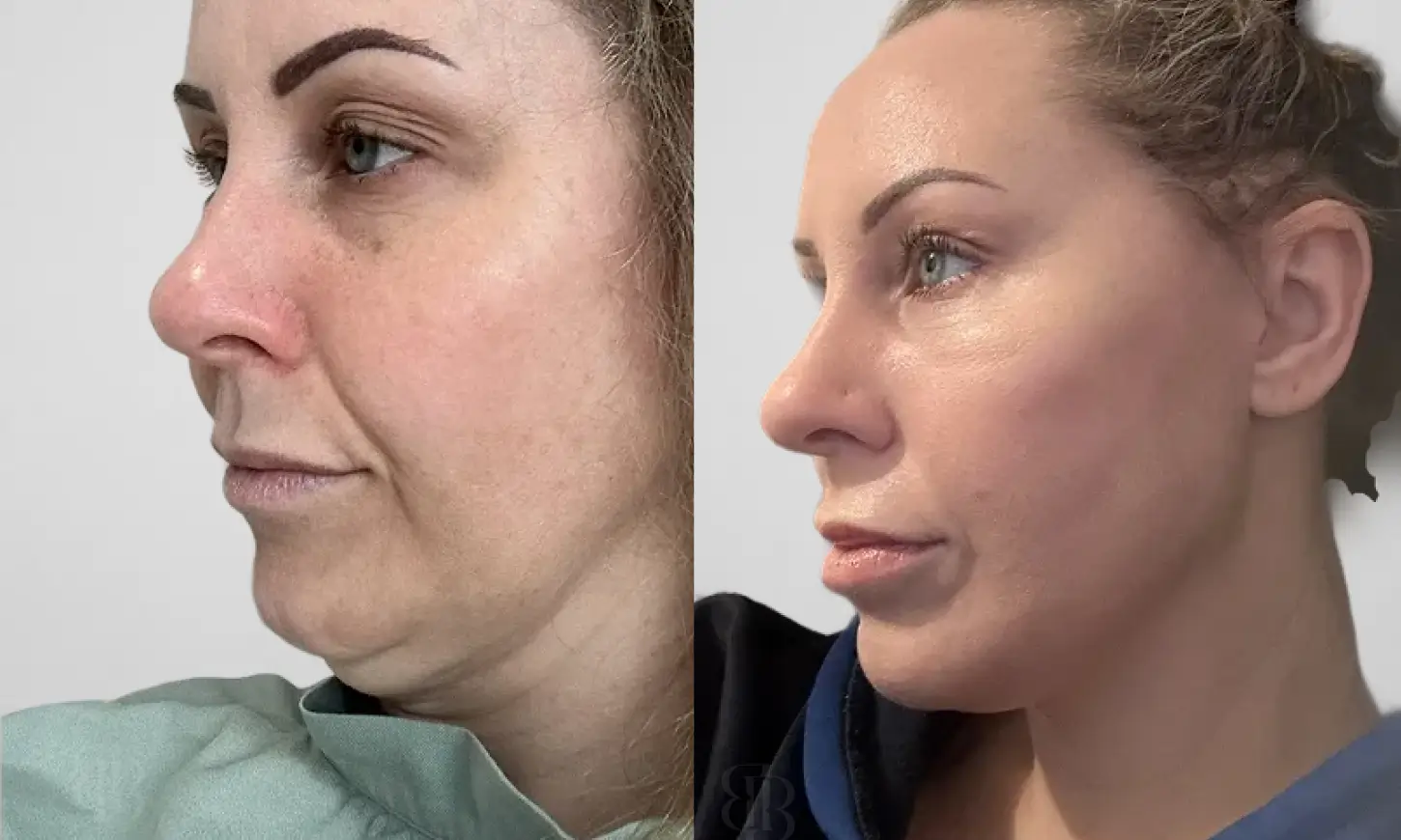 Before & After Mini Facelift