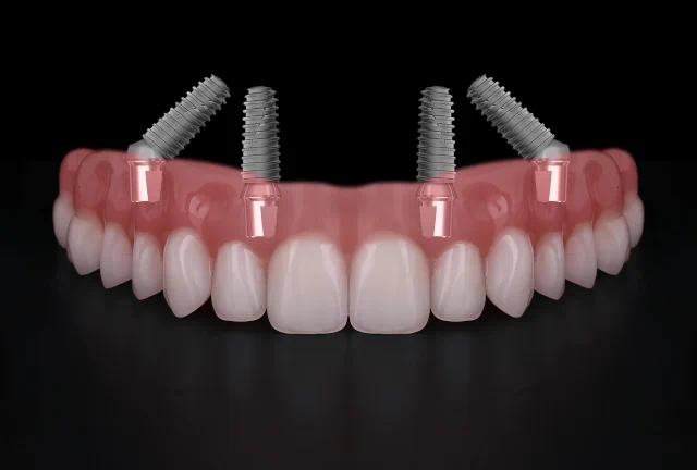 Komplett neue Methoden Gebiss mit All-on-4 Implantaten