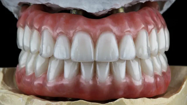 Was kostet ein komplettes Gebiss mit Implantaten