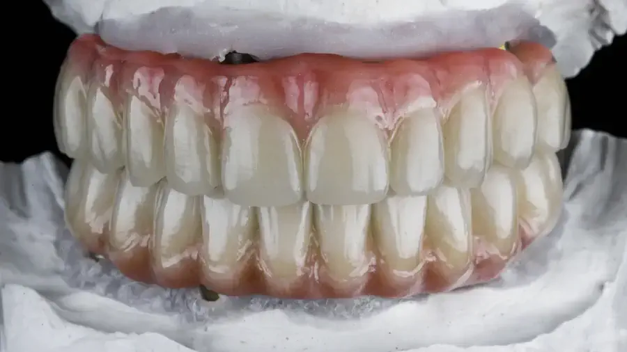 Zahnprothese was kostet ein komplettes Gebiss mit Implantaten