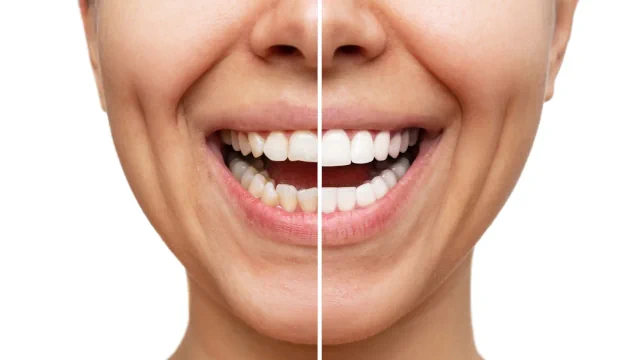 Veneers: Kosten, Ablauf, Haltbarkeit, Vor- und Nachteile