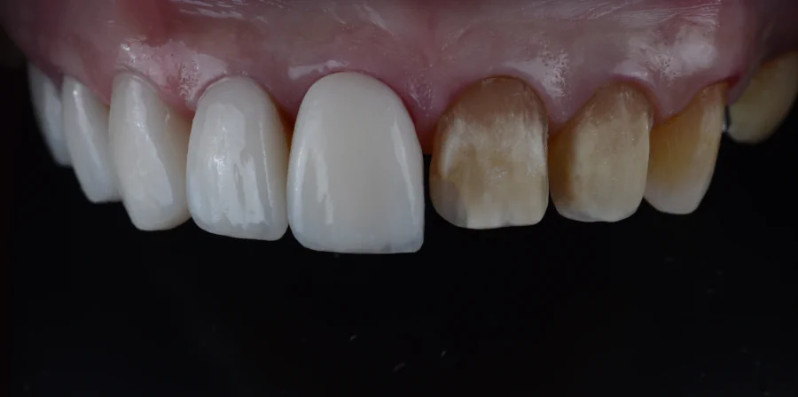 Veneers Zähne