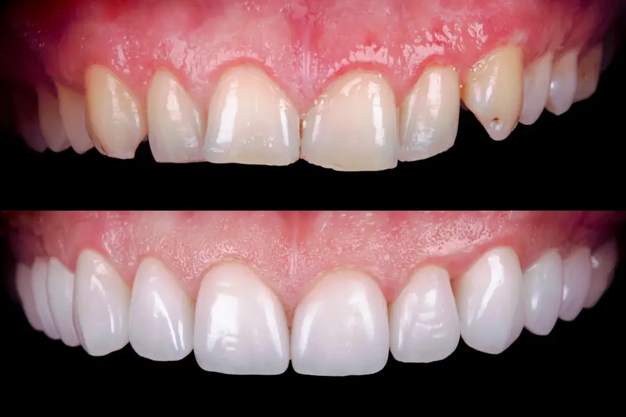 Veneers vorher nachher