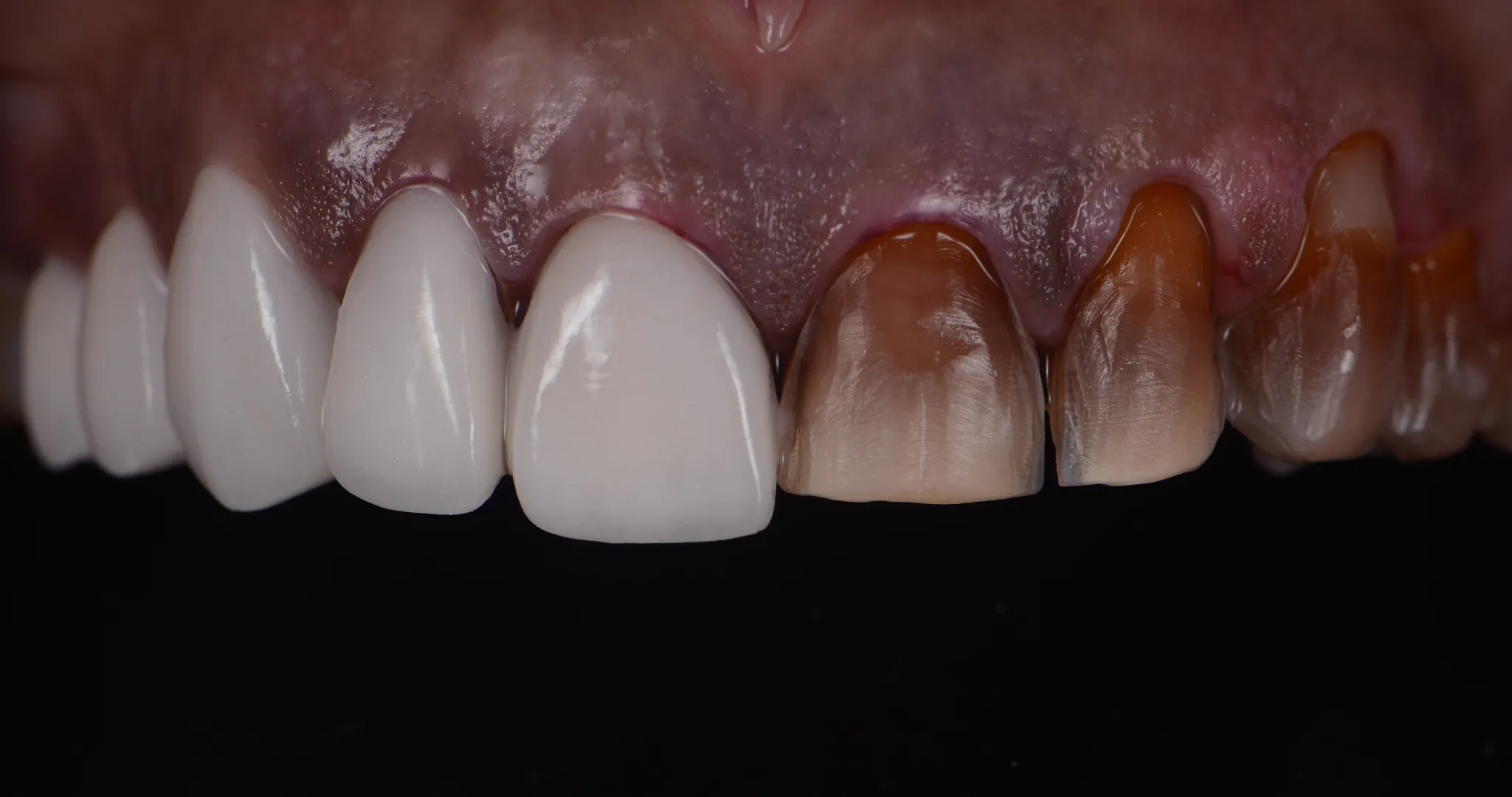 Veneers Kosten