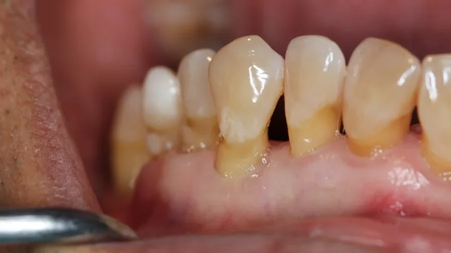 Zahnfleischrückgang Zahnfleisch geht zurück Zahnhals liegt frei