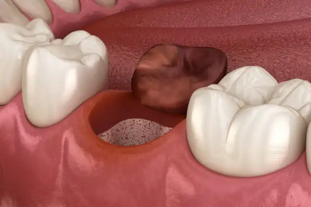 Wann löst sich der Blutpfropf nach dem Zahn ziehen?