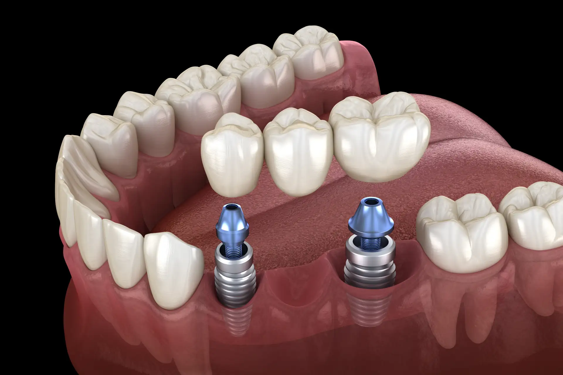 Implantat oder Brücke