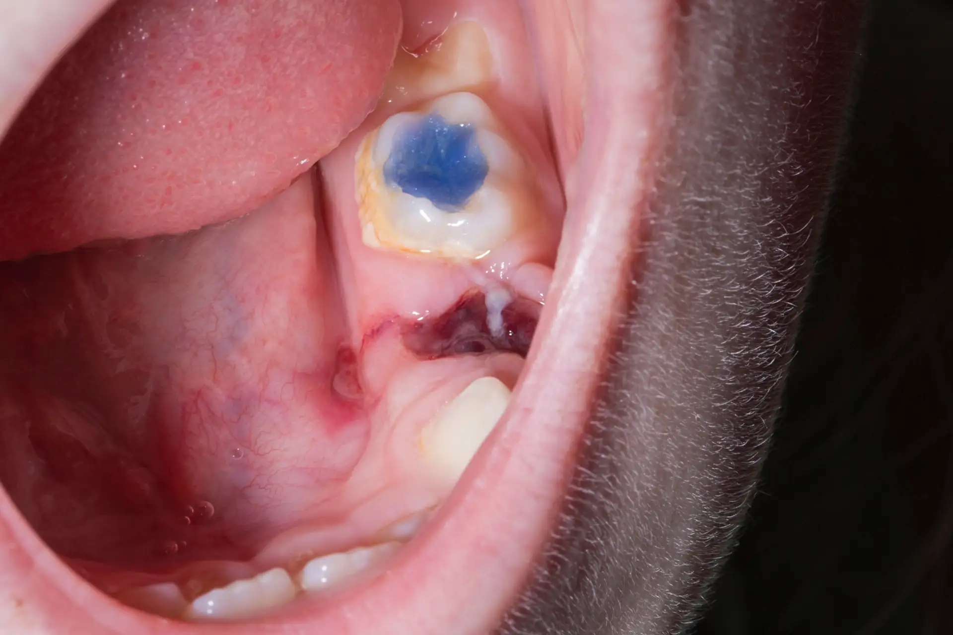 Zahn gezogen Wundheilung beschleunigen