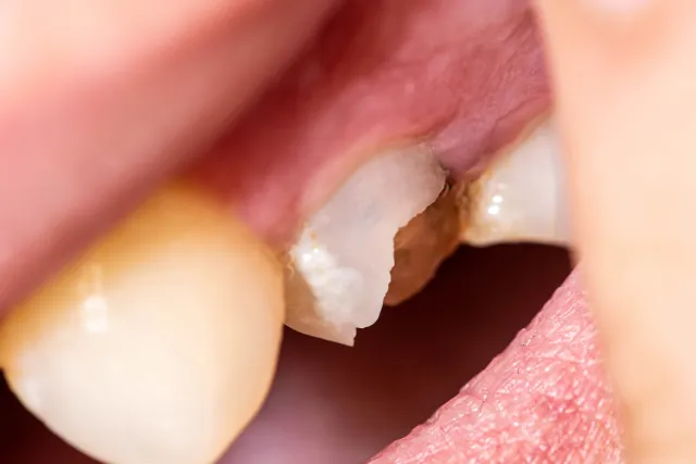 Zahn abgebrochen – was tun? Ursachen, Kosten & Behandlung