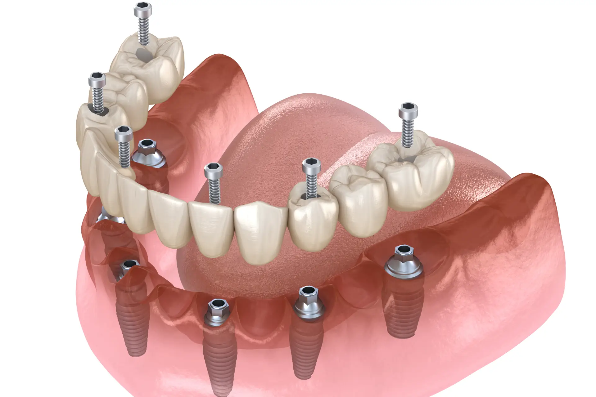 Alle Zähne ziehen lassen und Prothese einsetzen