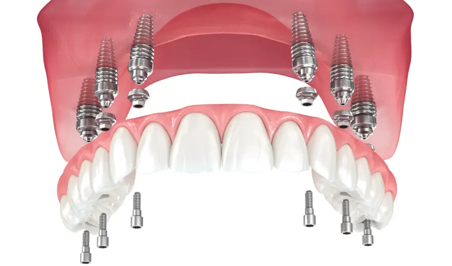 Alle Zähne ziehen lassen und Prothese