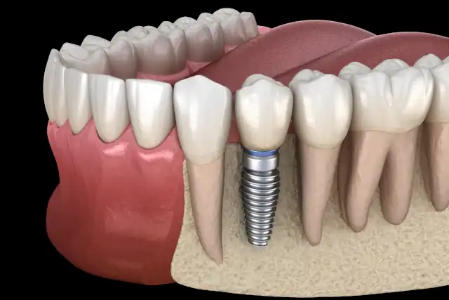 Zahnimplantate – Ablauf, Kosten, Vor- & Nachteile im Überblick