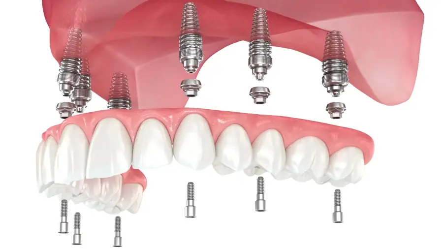 All-on-6 Implantate