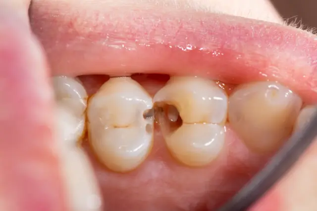 Loch im Zahn – was tun? Ursachen, Symptome, Schmerzen & Behandlung