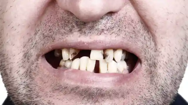 Schlechte Zähne mit 30: Ursachen, Folgen & Behandlung