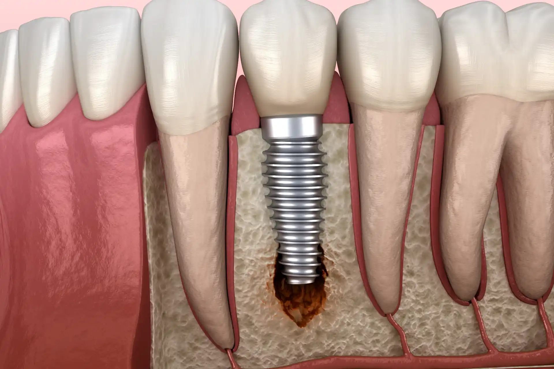 Periimplantitis