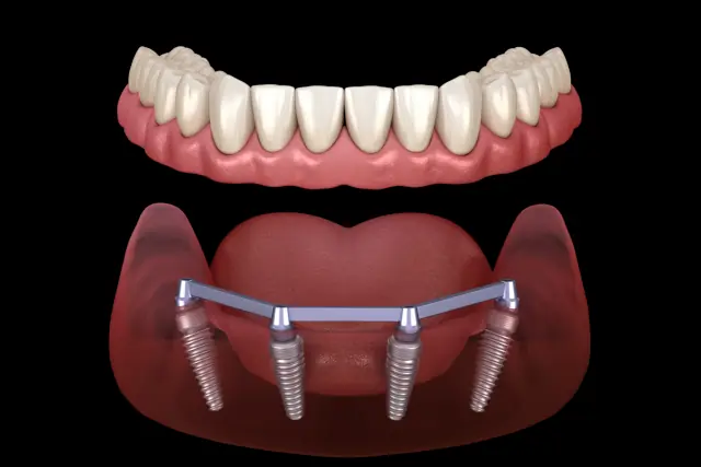 Stegprothese im Ober- & Unterkiefer: Kosten, Behandlung, Vor- & Nachteile
